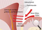 Schmerzempfindliche Zähne