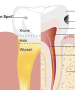 Zahn mit Kariesloch